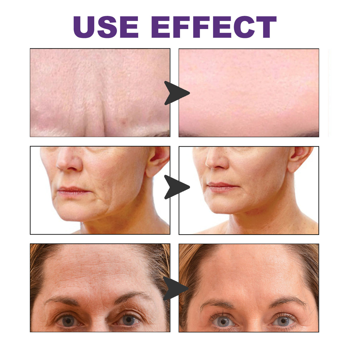 EELHOE Facial Wrinkle Patch, Droop Decree Line Lift Facial Skin Tightens Mouth Line Cheek Patch